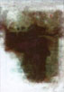 kidney stones